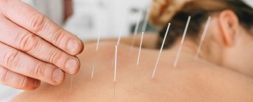 acupuntura