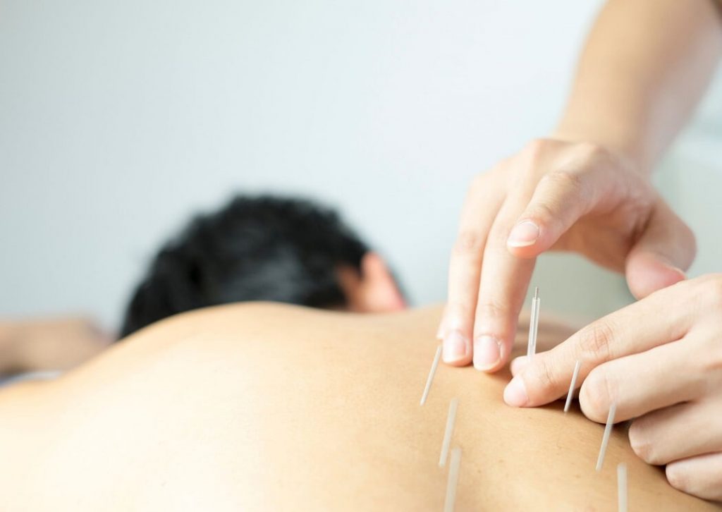 vantagens da acupuntura face a medicina tradicional