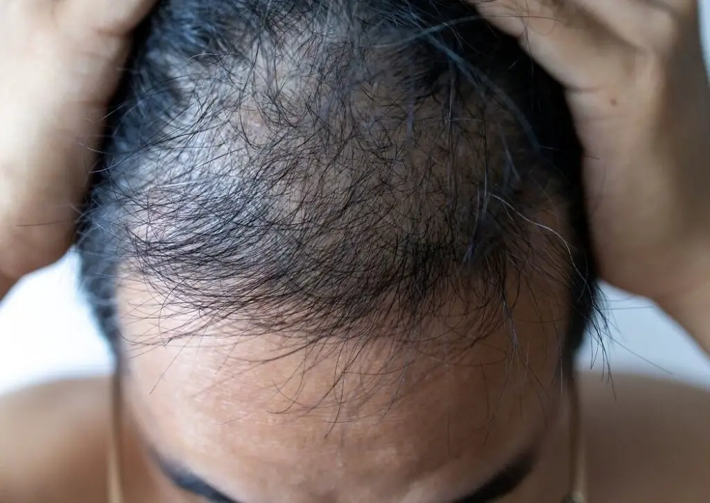 tratamento da alopecia